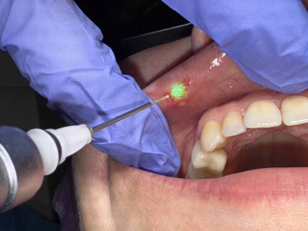 01_Tratament_laser_Denti_Service